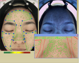 Portable Skin Analysis Cosmetic and Skin Therapist Dermis Layer Detect