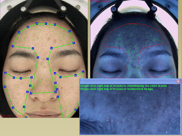 Medical Portable Skin Analyzer Therapist Dermis Layer 10 Years Experience