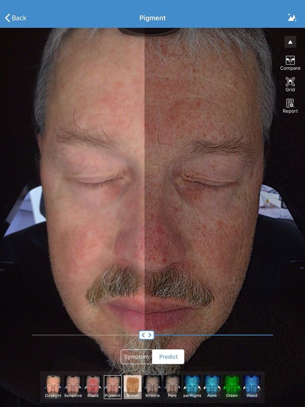 Facial 3d Skin Analyzer Scanner Visia 32gb Storage For Doctor Skin Clinic